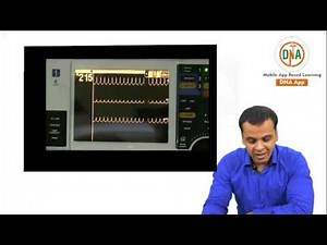 PSVT (Paroxysmal supraventricular tachycardia )