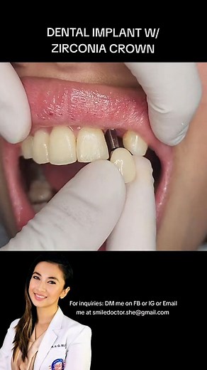 Replaced her missing front tooth with Single Unit Dental Implant w/ Zirconia Crown FOR INQUIRIES 🇵🇭: DM OR EMAIL US AT. smiledoctor.she@gmail.com #dentalimplantmanila #dentalimplant #digitaldentures #snapondentures #snapindentures #dentures #fixedbridge #aesthetics #smiletransformation #smilemakeover #denturephilippines #denturemanila #dentistmanila #dentistphilippines #denturecavite #dentalimplantphilippines #dentalclinicmanila #dentalclinicphilipines #ofw #miniimplant #removabledenture #cosm