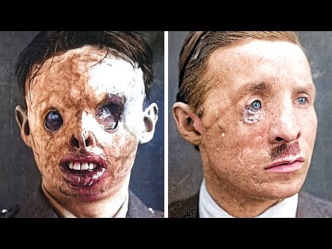 The Tragic History Of WW1 And Plastic Surgery