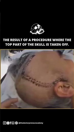 What Happens During a Craniotomy? 🧠 | Brain Surgery Explained Simply