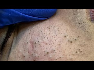 Extracting Large Blackheads And Whiteheads | Get Clear Glowing Skin