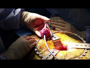 Open Radical prostate operation