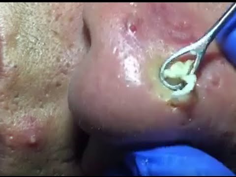 Wait for the NOSE!!! Blackhead ASMR Pimple Popping Video.