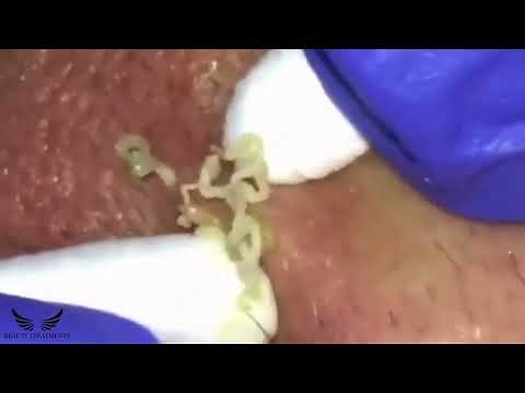 Blackhead Removal - Cystic Acne Treatment - Elderly Pimple Popping - Hidden Acne Spa Relaxing | #111