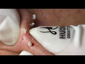 Make your Acne Treatment Huong Da Nang# Nhat is Back | acne 2023