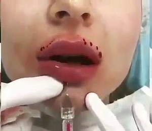 Can I Get Big Lips Through Injections ? Lip Augmentation. | I Love Medical Profession