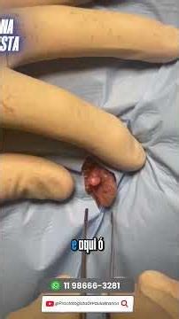 Skin tag, hemorrhoid, or fissure? Learn the difference before considering surgery #shortsvideo