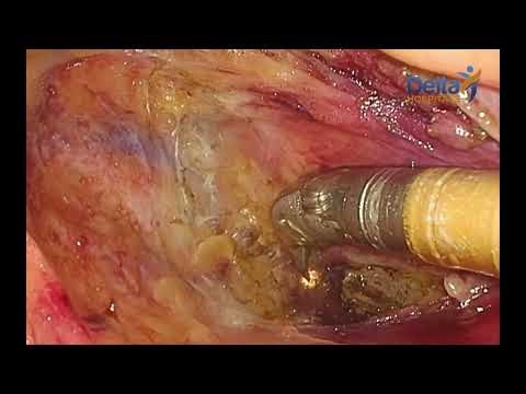 Robotic Ventral Mesh Rectopexy for Full-Thickness Rectal Prolapse | Pelvic Floor Surgery