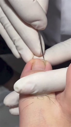 10K views · 163 reactions | #toenails #toes #feet #pedicure #nails #prettytoes #foot #footfetishnation #feetlovers #prettyfeet #feetworship #soles #feetpics #feetporn #toesfetish #feetfetishworld #softfeet #footfetish #footcare #barefeet #podiatrist #feetstagram #toe #cutefeet #pedicures #medical #reelsvideo #virals #followers #fyp | Emaly | Facebook