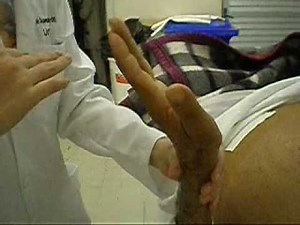 Flapping ou Asterixis