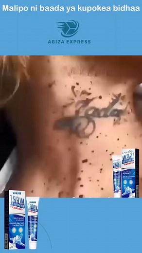 : 👋 Umechoshwa na vipele au ngozi inayojitokeza (skin tags) visivyotaka kuondoka? 🔥 Tunakuletea Sumifun Wart Remover Ointment – suluhisho la asili lisilo na maumivu kuondoa vipele na ngozi inayojitokeza bila makovu, na bila kurudi tena! 🌿 Imetengenezwa kwa viungo vya asili 💨 Inafanya kazi haraka na rahisi kupaka ❌ Hakuna upasuaji, hakuna kugandisha, hakuna maumivu ✅ Inafaa kwa uso, shingo, mikono, miguu na sehemu nyingine za mwili 💫 Maelfu tayari wamepata ngozi laini na safi wakiwa nyumbani