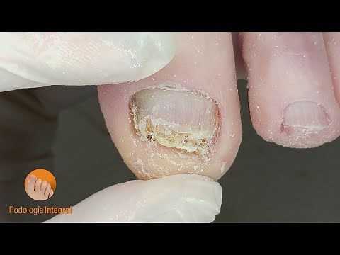 Deep cleaning of thick nails with fungus #podologiaintegral