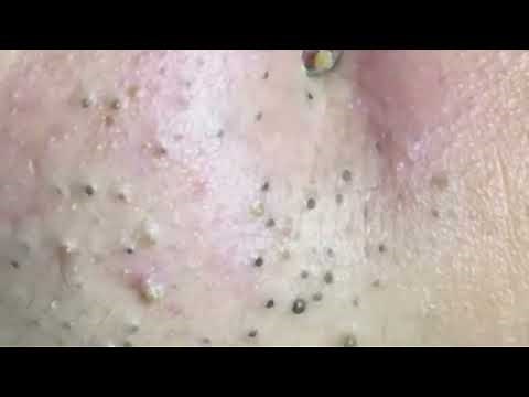 Blackhead Extraction: How to Safely Remove Them Without Scarring ‪@removeblackhead‬