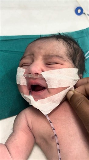 Newborn Baby NG Tube Removal Procedure in the NICU #NewbornBaby #NGTubeRemoval #NICUProcedure