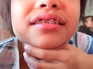 Tweens are making braces out of paper clips, rubber bands — and predictably, it's damaging their teeth
