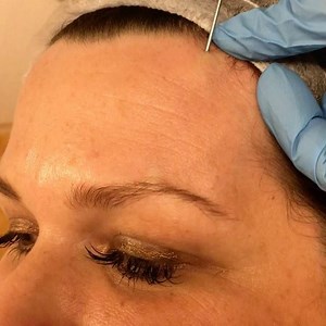 EYE BROW LIFT USING PDO THREADS 👀 . . Aim of the treatment is to lift the middle and lateral ends of the brow, giving a natural pull to open up the eye. . 💉PDO Cogs are used by injecting local anaesthetic into the area and inserting the cannula under the muscle . ✂️The threads are then pulled, twisted and cut to create a natural lift . 😳Result is immediately and gets better over 12 weeks as collagen starts to produce. . 🤔The thread then breaks down, leaving your natural collagen behind. . 💰