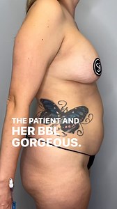 This patients full surgery was breast implant exchange from 385cc saline to 600cc gummy bear implants, core liposuction with renuvion taking approximately 3 Liters of fat off and a mini BBL with approx 800cc transferred to each side. Let me know what you think. #mommymakeover #minibble #liposculpture #liposuction @renuvion @allerganaesthetics | Andrew Ray