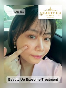 37K views · 160 reactions | Drသက်ထား ကိုယ်တိုင် Treatment ယူထားဖြစ်တဲ့ Beauty Up Exosome Treatment procedure အဆင့်ဆင့်နဲ့ and Dr အရမ်းကျေနပ်ရတဲ့ After Result လေးကိုလဲပြပေးထားပါတယ်ရှင့် #exosome #BeautyUp #BeautyUpSkin&Aesthetic Center | Beauty Up Skin & Aesthetic Center | Facebook