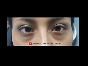 OCULAR FLUTTER (Residual). Dr Justiniano Zea. Lima-Perú.