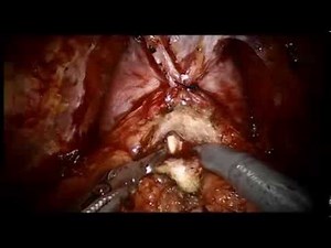 Prostatectomy - The Prostate Clinic