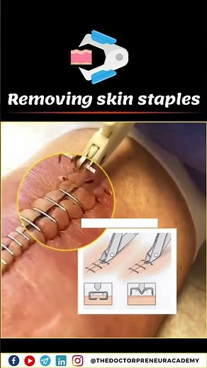 🔹 How to Remove Skin Staples Safely | Step-by-Step Guide 🩹✂️