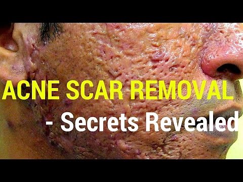 How to treat acne scars- Dermatology Secrets revealed