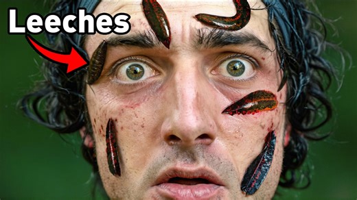 I Tried Leech Therapy!