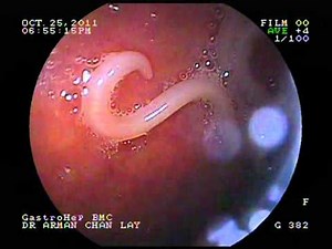 Ascaris ("roundworms")