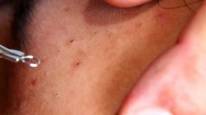 Close up on squeezing pimple blackheads from cheek of teenager with pimple popper tool