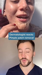 Dermatologist reacts to pimple patch removal It’s fun to watch pimple patches with a bunch of gunk on them being removed from acne, but a common misconception is that this gunk is pus being removed from a pimple. It’s not! Pimple patches are made from a type of bandage called a hydrocolloid bandage which is a type of gel bandage. When oil and moisturizer touch hydrocolloid, it transforms into more of an opaque gel substance which gives it the gunky color. Hydrocolloid bandages are helpful for pr