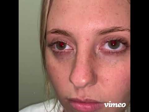 Levator Function Testing by Bailey Kargo