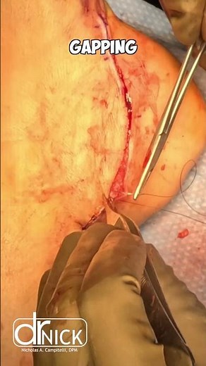 How To Suture : The Running Horizontal (real patient)