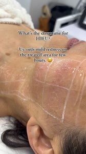 FAQ: What’s the downtime with HIFU? Am I gonna be able to go back to my usual daily activities? HIFU has no or only minimal downtime. We only recommend not to do any hot inducing activities for 24hrs after the treatment. The best part, nobody can notice you had a treatment done but you will feel a bit tender on the areas. ☺️💪 Happy Sunday! BOOK your HIFU treatment with us and we’ll make sure you’ll be in good hands! #HIFU #HIFUPERTH #PERTHHIFU #ULATHERAPY #ULATHERAPYPERTH #PERTHULATHERAPY #NONS