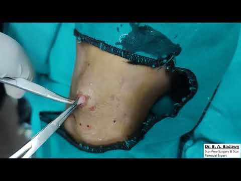 Scarless Big Dorsal Hand Ganglion ...كيس زلالى باليد