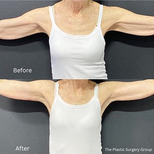 Empowering before and after photos of a Brachioplasty by Dr....