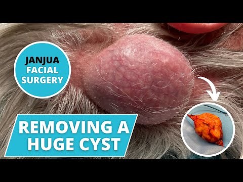 LARGE CYST REMOVAL ON MALE'S HEAD - DR. TANVEER JANJUA - NEW JERSEY