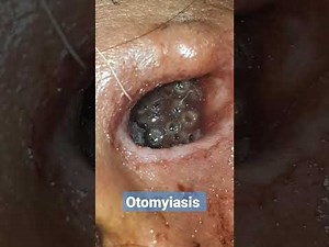 Otomyiasis - Maggots in ear