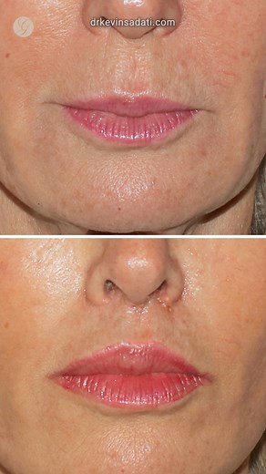 10K views · 109 reactions | Beautiful Lip Lift Results #lips #liplift #lipliftsurgery Gallery of Cosmetic Surgery & Aesthetic Lounge Dr Kevin Sadati, Facial Plastic Surgeon The Aesthetic Lounge | Kevin Sadati | Facebook
