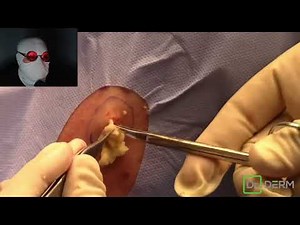 2 Exploding Cysts