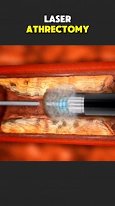 1.5K views | How Laser Atherectomy Procedure Is Performed 3D Animation #laseratherectomy #atherectomytreatment #plaque | Spine Health Care | Facebook