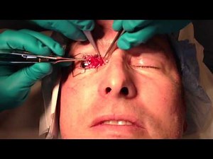 Strabismus Surgery with Adjustable Suture