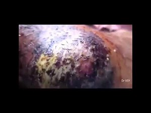 Draining horrible abscess on leg