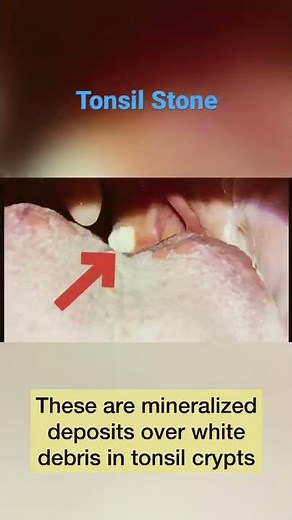 A large stone is seen in the left tonsil crypt | Tonsil stone
