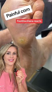 Shaving a painful corn! VC: #doctor #podiatry #callus #callusesremoval #foot | Footdocdana
