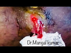 Popping Abscess on the Leg# drainage and packing