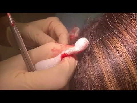 Scalp Cyst Removal