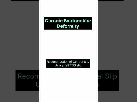 Chronic Central slip injury Reconstruction 