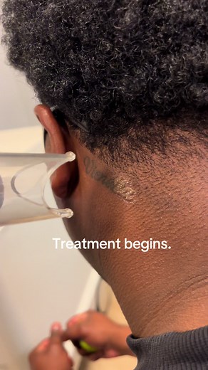 Behind the Ear Tattoo Removal Process in Virginia Beach