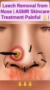 575K views · 1K reactions | Leech Removal from Nose | ASMR Skincare Treatment Painful | #video #reels #viral #trending #fblifestyle #fbreelsfypシ゚ #shorts | Akhilesh Yadav | Facebook