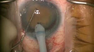 How to Disassemble a Morgagnian Cataract - Eyetube